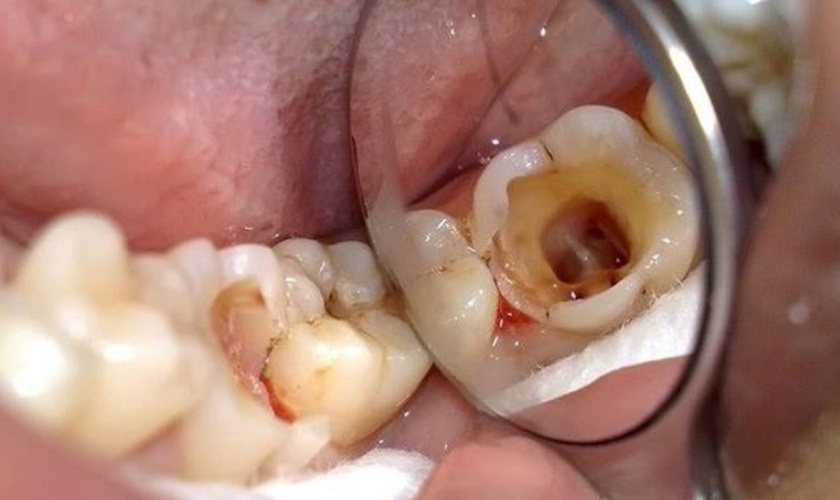 Răng hàm bị vỡ khiến ăn nhai khó khăn